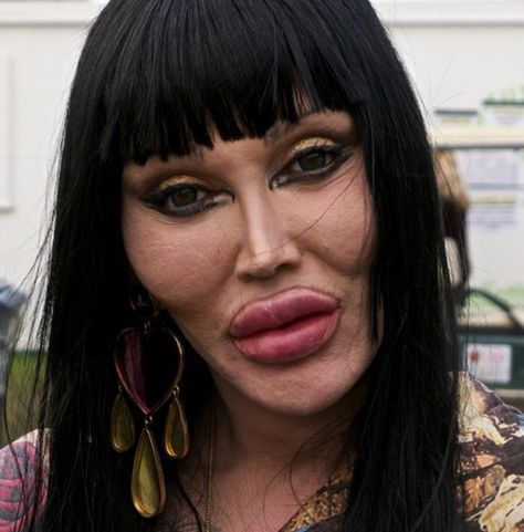 Plastic Surgery Pictures, Botched Plastic Surgery, Bad Plastic Surgeries, Plastic Surgery Fail, Scary People, Botox Before And After, Pete Burns, Plastic Surgery Gone Wrong, Makeup Fails