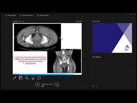 Hypercalcemia