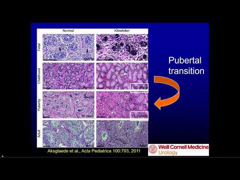 Management of Klinefelter/Severe Male Infertility