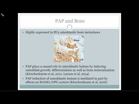 Prostate Cancer Osteoblastic Bone Metastases