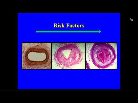 Regressing Atherosclerosis in Diabetes: Insights into Why This is Hard to Achieve