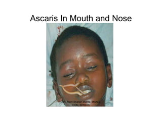 Ascaris In Mouth and Nose




       DR. Ram Sharan Mehta, MSND,
              CON, BPKIHS
 