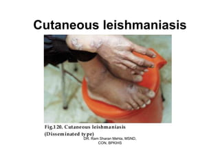 Cutaneous leishmaniasis




       DR. Ram Sharan Mehta, MSND,
              CON, BPKIHS
 