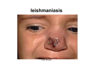 leishmaniasis




 DR. Ram Sharan Mehta, MSND,
        CON, BPKIHS
 