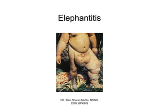 Elephantitis




DR. Ram Sharan Mehta, MSND,
       CON, BPKIHS
 