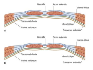 Abdominal wall anatomy 