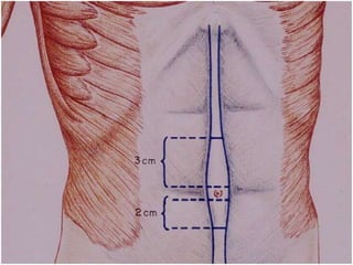 Abdominal wall anatomy 