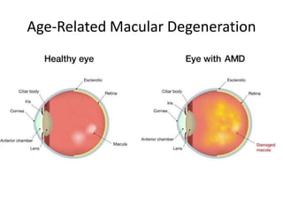 Age-Related Macular Degeneration
 