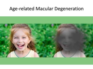 Age-related Macular Degeneration
 