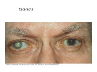 Cataracts
 