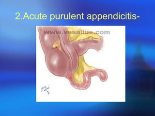 2.Acute purulent appendicitis-

 