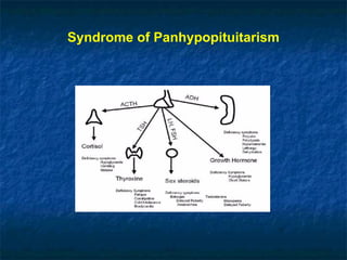 Syndrome of Panhypopituitarism
 