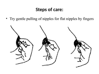 Steps of care:
• Try gentle pulling of nipples for flat nipples by fingers
 