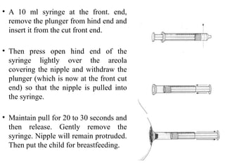 • A 10 ml syringe at the front. end,
remove the plunger from hind end and
insert it from the cut front end.
• Then press open hind end of the
syringe lightly over the areola
covering the nipple and withdraw the
plunger (which is now at the front cut
end) so that the nipple is pulled into
the syringe.
• Maintain pull for 20 to 30 seconds and
then release. Gently remove the
syringe. Nipple will remain protruded.
Then put the child for breastfeeding.
 