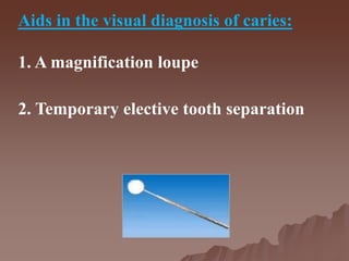 Aids in the visual diagnosis of caries:
1. A magnification loupe
2. Temporary elective tooth separation
 