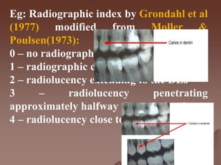 Eg: Radiographic index by Grondahl et al
(1977) modified from Moller &
Poulsen(1973):
0 – no radiographic changes in enamel
1 – radiographic changes in enamel
2 – radiolucency extending to the DEJ
3 – radiolucency penetrating
approximately halfway through dentin
4 – radiolucency close to the pulp.
 