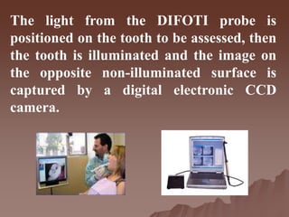 The light from the DIFOTI probe is
positioned on the tooth to be assessed, then
the tooth is illuminated and the image on
the opposite non-illuminated surface is
captured by a digital electronic CCD
camera.
 