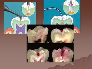 Caries diagnosis