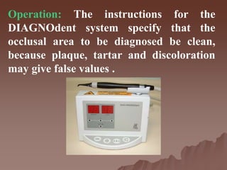 Operation: The instructions for the
DIAGNOdent system specify that the
occlusal area to be diagnosed be clean,
because plaque, tartar and discoloration
may give false values .
 