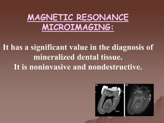 MAGNETIC RESONANCE
MICROIMAGING:
It has a significant value in the diagnosis of
mineralized dental tissue.
It is noninvasive and nondestructive.
 