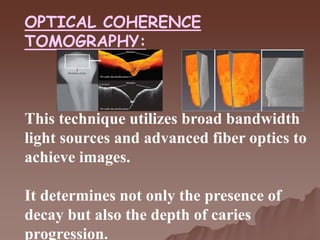 OPTICAL COHERENCE
TOMOGRAPHY:
This technique utilizes broad bandwidth
light sources and advanced fiber optics to
achieve images.
It determines not only the presence of
decay but also the depth of caries
progression.
 