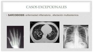 • SARCOIDOSIS: enfermedad inflamatoria , afectación multisistemica
CASOS EXCEPCIONALES
 