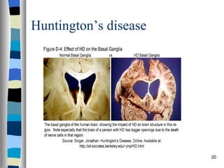 Huntington’s disease 