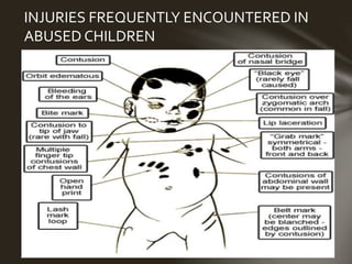 INJURIES FREQUENTLY ENCOUNTERED IN 
ABUSED CHILDREN 
 