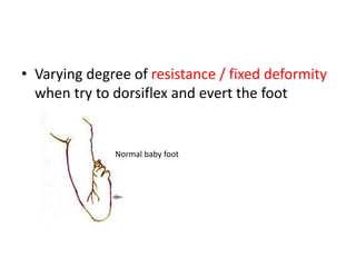 • Varying degree of resistance / fixed deformity
when try to dorsiflex and evert the foot
Normal baby foot
 