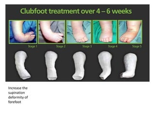 Increase the
supination
deformity of
forefoot
 