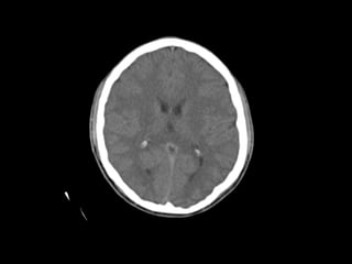 Esclerosis mesial temporal