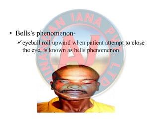 • Bells’s phenomenon-
eyeball roll upward when patient attempt to close
the eye, is known as bells phenomenon
 