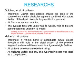 RESEARCHS Goldberg et al: 9 patients Treatment: Dacron tape passed around the base of the coracoid and medial clavicular segment combined with suture fixation of the distal clavicular fragment to the proximal All fractures went on to union.  The average time until union was 16 weeks, with all but one patient obtaining union by 18 weeks.   Goldberg JA, Bruce WJ, Sonnabend DH, et al. Type 2 fractures of the distal clavicle: a new surgical technique. J Shoulder Elbow Surg 1997;6:380-382 Mall et al:  12 patients Treatment: a 10-mm band of absorbable suture placed through a drill hole in the distal aspect of the proximal fragment and around the coracoid in a figure-of-eight fashion.  All patients achieved an excellent rating All fractures united, and only one hypertrophic scar was listed as a complication. 