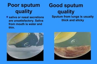 Poor sputum
quality
saliva or nasal secretions
are unsatisfactory. Saliva
from mouth is water and
thin.

Good sputum
quality
Sputum from lungs is usually
thick and sticky

 