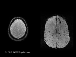 T2 GRE: SWAN hipointensos
 