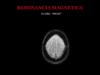 RESONANCIA MAGNETICA
T2 GRE : “SWAN”
 