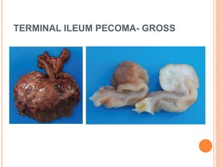 TERMINAL ILEUM PECOMA- GROSS
 