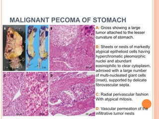 MALIGNANT PECOMA OF STOMACH
A: Gross showing a large
tumor attached to the lesser
curvature of stomach.
B: Sheets or nests of markedly
atypical epithelioid cells having
hyperchromatic pleomorphic
nuclei and abundant
eosinophilic to clear cytoplasm,
admixed with a large number
of multi-nucleated giant cells
(inset), supported by delicate
fibrovascular septa.
C: Radial perivascular fashion
With atypical mitosis.
D: Vascular permeation of the
infiltrative tumor nests
 