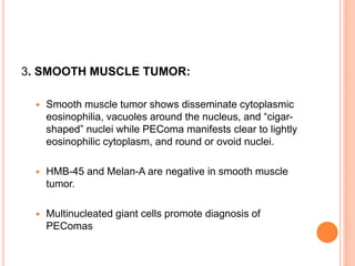 3. SMOOTH MUSCLE TUMOR:
 Smooth muscle tumor shows disseminate cytoplasmic
eosinophilia, vacuoles around the nucleus, and “cigar-
shaped” nuclei while PEComa manifests clear to lightly
eosinophilic cytoplasm, and round or ovoid nuclei.
 HMB-45 and Melan-A are negative in smooth muscle
tumor.
 Multinucleated giant cells promote diagnosis of
PEComas
 