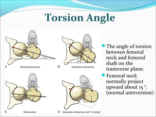 Torsion Angle
The angle of torsion
between femoral
neck and femoral
shaft on the
transverse plane.
Femoral neck
normally project
upward about 15 °.
(normal anteversion)
 