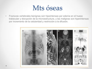 Mts óseas
• Fracturas vertebrales benignas son hipointensas por edema en el hueso
trabecular y disrupción de la microestructura, y las malignas son hiperintensas
por incremento de la celularidad y restricción a la difusión.
 