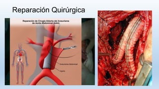 Reparación Quirúrgica
 