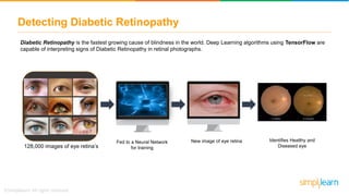 Detecting Diabetic Retinopathy
Diabetic Retinopathy is the fastest growing cause of blindness in the world. Deep Learning algorithms using TensorFlow are
capable of interpreting signs of Diabetic Retinopathy in retinal photographs.
128,000 images of eye retina’s
Fed to a Neural Network
for training
New image of eye retina Identifies Healthy and
Diseased eye
 