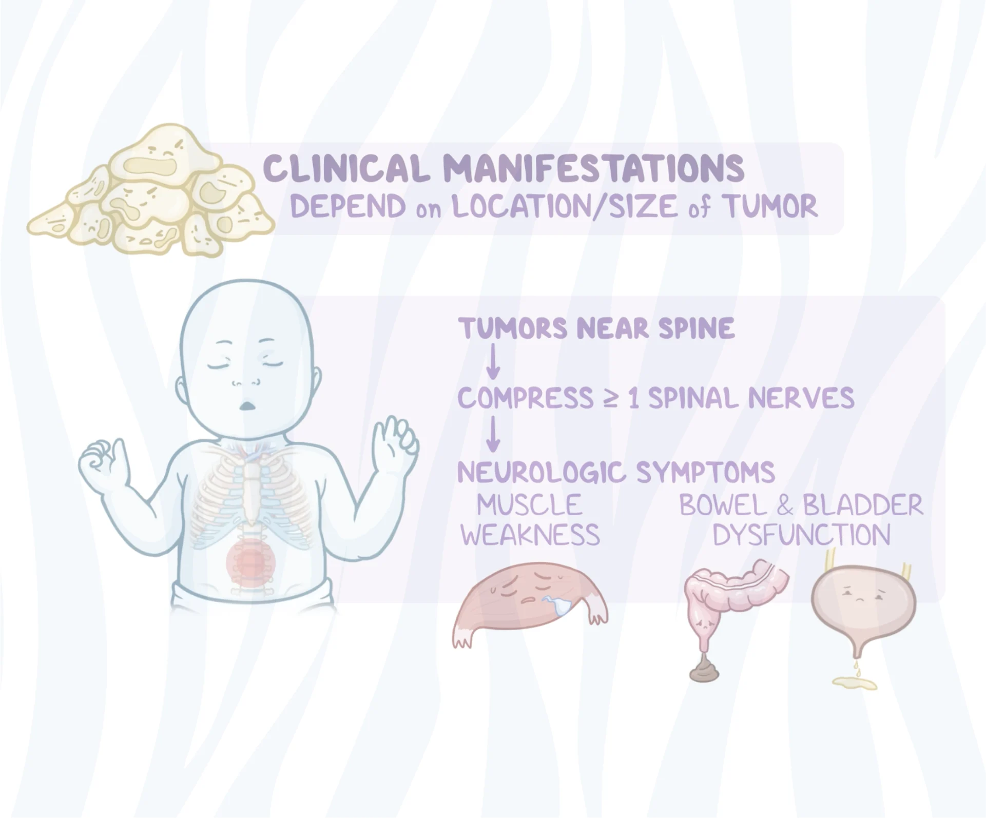 zebra_Neuroblastoma video image