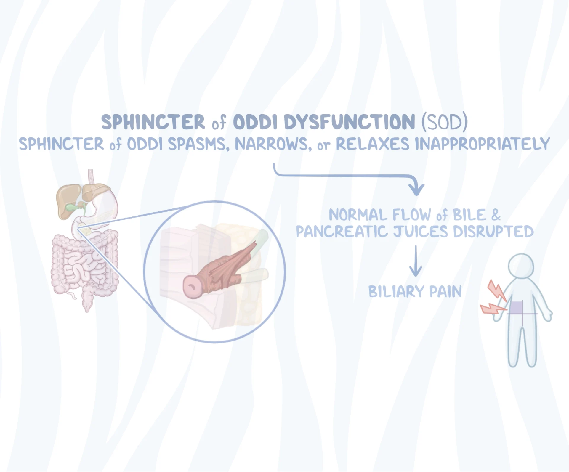 zebra_Sphincter of Oddi Dysfunction poster image