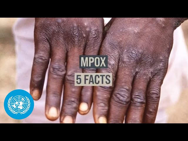 Mpox: Key Facts