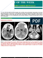 6M Case Report Postinfectious Cerebellitis