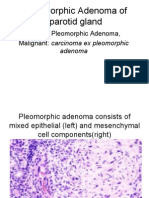 Pleomorphic Adenoma of Parotid Gland