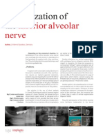 Lateralisation of Alv Nerve