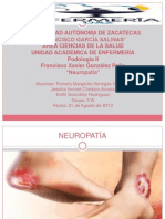 Neuropatía